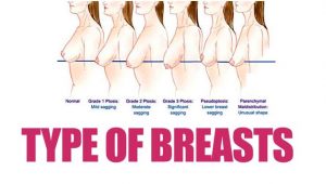 Types Of Breast